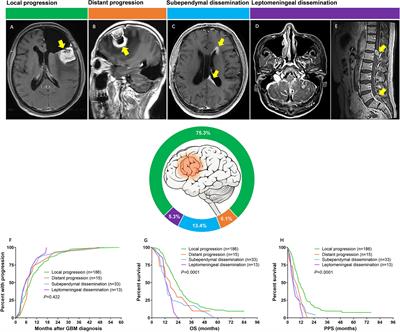 Classification of Progression Patterns in Glioblastoma: Analysis of Predictive Factors and Clinical Implications